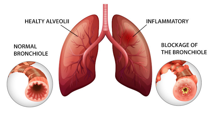 COPD illustration