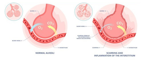 ILD illustration