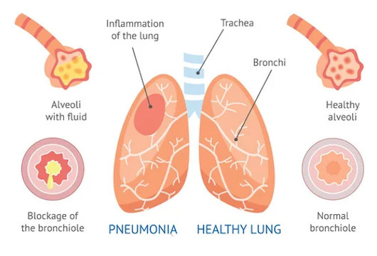 Pneumonia illustration