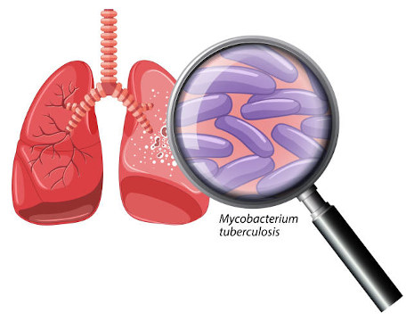 Tuberculosis illustration